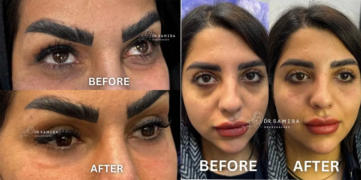 تزرق ژل و بوتاکس کلینیک رویال مشهد