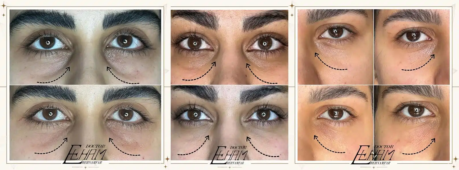 بوتاکس و تزرق ژل دکتر الهام بهنامفر